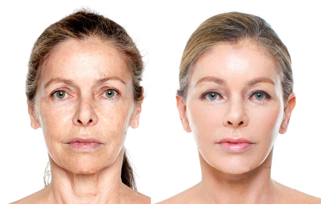 The Ideal Candidate For A Deep Plane Facelift